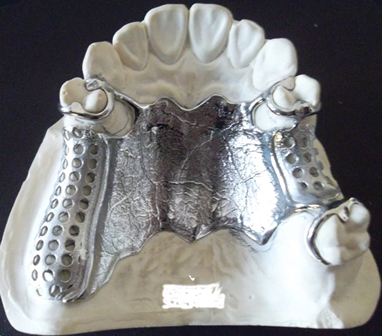 Dental work from 3D Systems of Rock Hill, S.C.. Direct metal dentistry